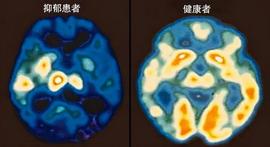抑郁症做正规治疗和吃药是康复捷径，也要做心理治疗和自我成长_: