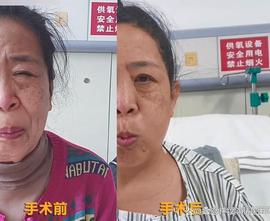 病例：阿姨面抽6年，逢人就做“鬼脸”，颅内找到“越轨”的血管_: