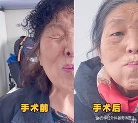 「病友故事」不止面子问题，面肌痉挛15年，她亲自讲述自己的感受_: